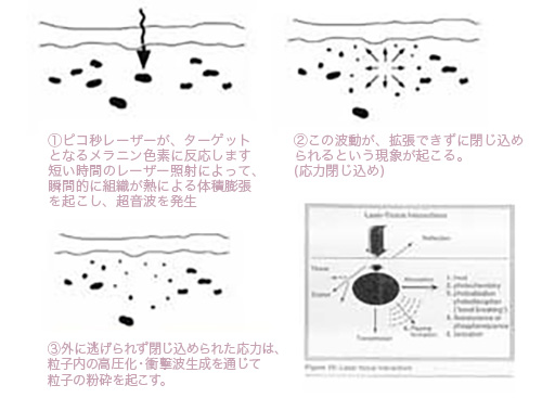 シミ除去