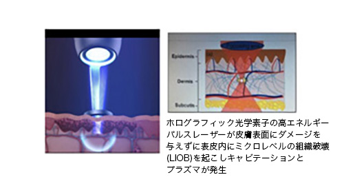 ピコフラクショナル