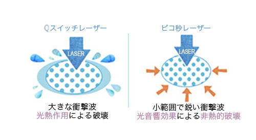 ピコトーニング